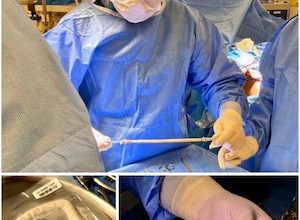 Photo of Hospital de Calama realizó la primera cirugía de traumatología con injertos del Banco de Huesos