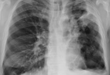 Photo of Hospital de Calama alerta: aumentan los casos de tuberculosis y llaman a consultar precozmente